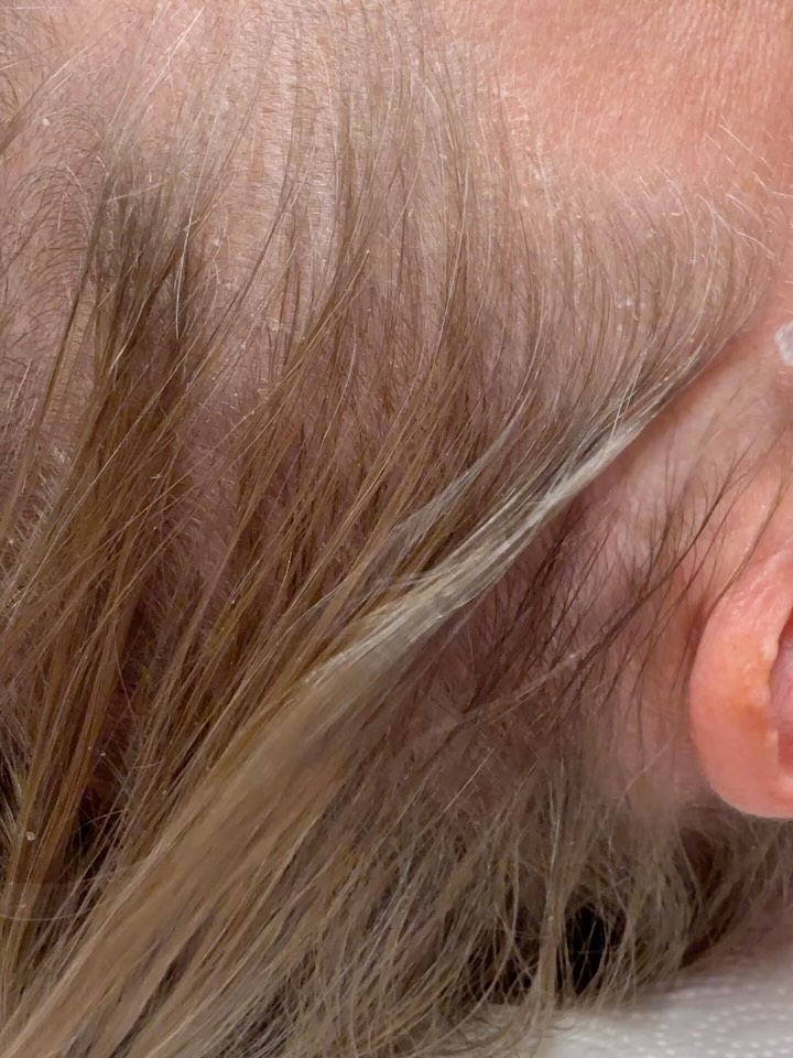 Warum eine schuppige Kopfhaut keine Nährstoffe mehr aufnimmt - und wie JetPeel helfen kann
Eine gesunde Kopfhaut ist die Basis für kräftiges, gesundes Haar. Doch viele Menschen leiden unter einer schuppigen, trockenen oder gereizten Kopfhaut - oft ohne zu wissen, dass dies die Aufnahme von Pflege- und Nährstoffen erheblich beeinträchtigen kann.
Die Ursachen: Blockierte Hautbarriere durch
Schuppenbildung
Bei einer schuppigen Kopfhaut ist die natürliche Hautbarriere gestört. Talg, abgestorbene Hautzellen und Stylingrückstände sammeln sich an der Oberfläche, verstopfen die Poren und behindern die Durchblutung. Infolgedessen können Wirkstoffe aus Pflegeprodukten die Kopfhaut nicht mehr richtig durchdringen. Selbst hochwertige Seren oder Nährstoffe bleiben wirkungslos, da sie nicht bis zu den Haarwurzeln vordringen können, wo sie eigentlich gebraucht werden.
Die Lösung: Tiefenreinigung und Aktivierung mit JetPeel
JetPeel ist eine innovative, nicht-invasive Technologie zur Haut- und Kopfhautbehandlung.
Mit Hilfe eines feinen Hochdruckstrahls aus Luft und Wirkstofflösungen werden die oberen Haut-schichten sanft und schmerzfrei abgetragen.
So werden Talgablagerungen, Schuppen und Verunreinigungen gründlich entfernt, ohne die Kopfhaut zu reizen.
Das Besondere: Zeitgleich mit der Reinigung werden tiefenwirksame Vitamine, Hyaluron oder andere individuell abgestimmte Wirkstoffe in die Haut eingeschleust - ganz ohne Nadeln.
Dadurch wird nicht nur die Kopfhaut intensiv gepflegt, sondern auch die Aufnahmefähigkeit für Nährstoffe signifikant verbessert.
Das Ergebnis: Eine saubere, ausgeglichene und aufnahmefähige Kopfhaut
Teste die Jetpeel Behandlung in unserem Institut in Hannover
