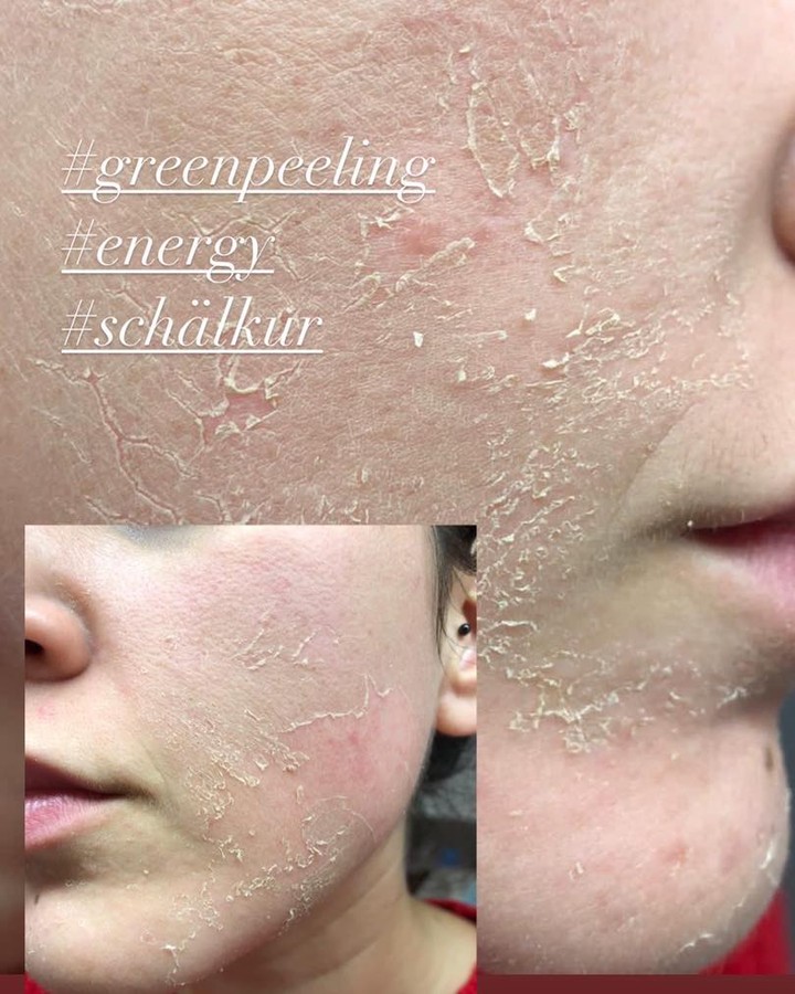 #greenpeeling #schälkur #hauterneuerung #akne #aknebehandlung #pigmentflecken #fresh #reinehaut #antiaging #feineporen #ausreinigung #kosmetikstudio #salzburg #zertifiziert #kosmetik #dauerhaftehaarentfernung #diodenlaser #waxing #sugaring #lashlifting