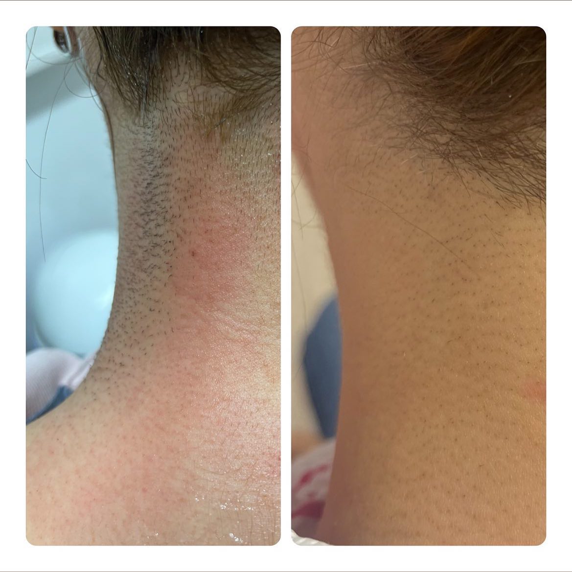 Woow nach nur einer Behandlung! #happycostumers❤️ #google #bewertung #feedback #kunden #dauerhaftehaarentfernung #haarfrei #kosmetik #beauty #sugaring #waxing #microneedling #microdermabrasion #hydratingskincare #kosmetikstudio #salzburg #salzburgstadt #salzburgland