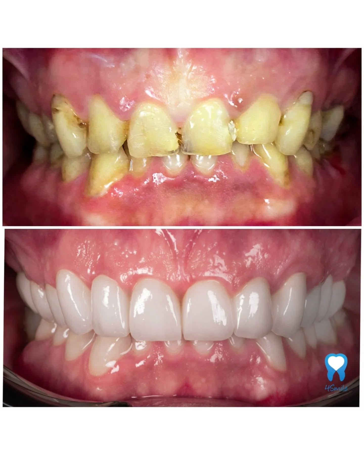 💪🤩💯 POVRATAK ZDRAVLJA I ESTETIKE OSMIJEHA - 15 cirkon-keramičkih zubnih krunica 💪🤩💯
Današnji slučaj savršen je primjer kako se kroz preciznu dentalnu medicinu i vrhunsku estetiku može u potpunosti transformirati oralno zdravlje i ljepota osmijeha.
Pacijent nam se obratio s ozbiljnim problemima koji su zahtijevali liječenje i obnovu čvrstoće i estetike osmijeha.
👉 Naš cilj bio je jasan: spasiti i ojačati prirodne zube te vratiti zdrav i blistav osmijeh. 🔁
➡️ Doktor Ivan Antolković kreirao je novi osmijeh kroz precizno planirane faze:
1️⃣ ENDODONTSKO LIJEČENJE I SANACIJA ZUBA
- Prvi i najvažniji korak bio je potpuno izliječiti bolesne zube. Nakon uspješne endodontske terapije, na te zube smo postavili specijalne nadogradnje. One služe kao maksimalno čvrsta i sigurna baza koja će dugoročno nositi nove zubne krunice.
2️⃣ 12 CIRKON-KERAMIČKIH KRUNICA U GORNJOJ ČELJUSTI
- Nakon sanacije podloge, gornju čeljust smo u potpunosti transformirali s pomoću 12 vrhunskih cirkon-keramičkih zubnih krunica. One su pacijentu vratile idealan oblik, prirodnu bjelinu i savršenu harmoniju gornjeg niza zuba.
3️⃣ ESTETSKO I FUNKCIONALNO USKLAĐIVANJE DONJE ČELJUSTI
- Donju čeljust smo stabilizirali i estetski povezali s gornjom kroz tri ključna koraka: postavili smo 2 cirkon-keramičke krunice na donje šestice te 1 krunicu na zubnom implantatu, čime smo u potpunosti vratili narušenu funkciju žvakanja i stabilnost zagriza.
👉 Rezultat je impresivan: osmijeh koji ponovno zrači zdravljem uz savršenu funkciju i estetiku vrhunskih materijala! 👌😁💯
💬 Skrivaš osmijeh zbog bolesnih zuba ili jednostavno želiš vratiti osmijehu sjaj?
Zamisli da ponovno možeš:
✨ Smijati se bez zadrške i s ponosom pokazati zube
✨ Jesti bez ikakve nelagode
✨ Imati ujednačen, čvrst i blistav niz zuba u obje čeljusti
Naš stručni 4Smile tim i najsuvremenija tehnologija spremni su za tvoju transformaciju! 😁
📲 Javi nam se u inbox za besplatne konzultacije i tvoj personalizirani plan transformacije osmijeha već danas! 💪🦷💙
#beforeandafter #prijeposlije #keramickezubnekrunice #stomatologzagreb #dentistacroazia