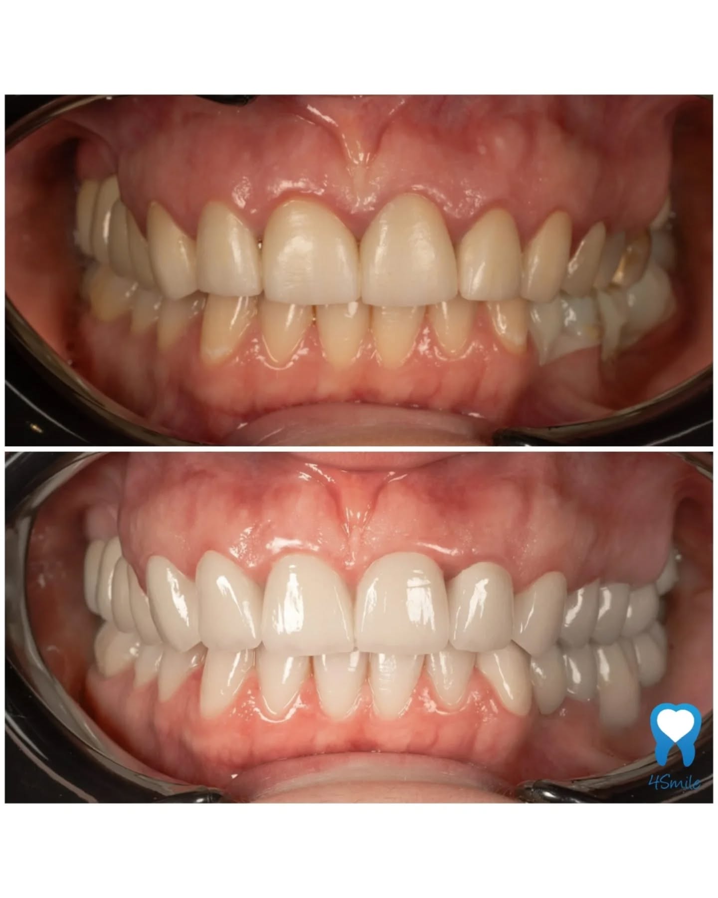 ✨😁🔝 OD STARIH KOMPOZITNIH LJUSKICA DO ZDRAVOG I BLISTAVOG OSMIJEHA UZ KERAMIČKE ZUBNE KRUNICE ✨😁🔝
Kada stari dentalni radovi više ne ispunjavaju svoju estetsku funkciju a oralno zdravlje je ugroženo , vrijeme je za obnovu zdravlja osmijeha i vrhunsku transformaciju!
Danas vam ponosno pokazujemo kako smo pacijentici vratili zdravlje i maksimalno samopouzdanje. 💪
👉 Pacijentica nam se obratila sa starim kompozitnim zubnim ljuskicama u gornjoj čeljusti koje su s vremenom izgubile svoj sjaj, no veći problem skrivao se ispod površine.
Zubima je bila potrebna hitna i temeljita sanacija zdravlja kako bismo osigurali dugovječnost novog osmijeha.
➡️ Doktor Ivan Antolković i naš stručni tim proveli su plan obnove osmijeha:
1️⃣ LIJEČENJE I SANACIJA ZUBA - ZDRAVLJE KAO TEMELJ:
Prva i najvažnija faza bila je detaljno liječenje i sanacija zuba ispod starih kompozitnih zubnih ljuskica. Pripremili smo čvrste i sigurne temelje koji će nositi novu, blistavu estetiku i održati funkciju zuba.
2️⃣ 10 CIRKON KERAMIČKIH KRUNICA U GORNJOJ ČELJUSTI:
Nakon uspješnog liječenja, gornji niz zuba potpuno smo transformirali s pomoću 10 vrhunskih cirkon-keramičkih krunica. Cirkon-keramika nam je omogućila da postignemo prirodnu transparenciju, savršen oblik i prirodnu bjelinu koja savršeno pristaje licu pacijentice.
👉 Rezultat? Prirodan, zdrav i harmoničan osmijeh! 🤩💯👌
💬 Imaš osjećaj da tvoji stari dentalni radovi više nisu ono što su bili? Primjećuješ probleme ispod njih ili jednostavno želiš osmijeh koji ponosno pokazuješ?
Zamisli osjećaj kada možeš:
✨ Široko se nasmijati bez skrivanja i nesigurnosti
✨ Biti potpuno siguran u zdravlje i čvrstoću svojih zuba
✨ Imati savršen niz koji izgleda potpuno prirodno i svježe
Tvoj put do zdravog i blistavog osmijeha počinje ovdje.
📲 Javi nam se u inbox, rezerviraj svoj termin za besplatne konzultacije i napravimo prvi korak prema tvom novom osmijehu već danas! 🧡
#beforeandafter #prijeposlije #hollywoodsmile #keramickezubnekrunice #dentistacroazia